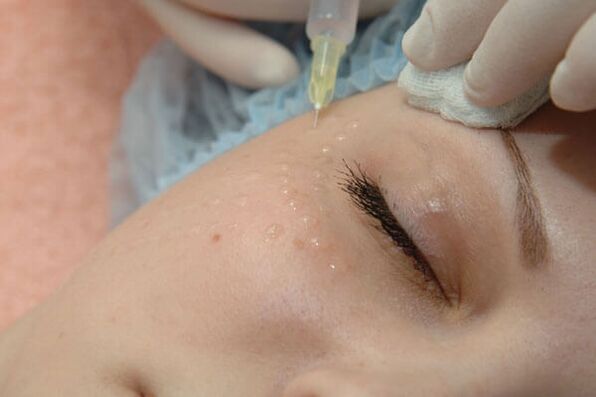 Mesoterapia - un método de inyección para rejuvenecer la piel de la cara