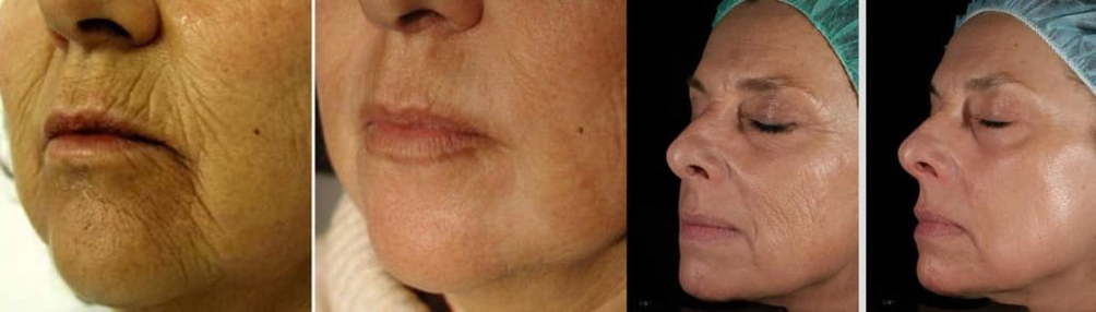 Piel del rostro antes y después del rejuvenecimiento con láser. 