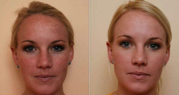 antes y después del rejuvenecimiento facial con láser