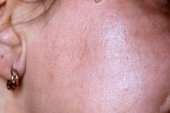 Enrojecimiento de la piel después del rejuvenecimiento con láser. 