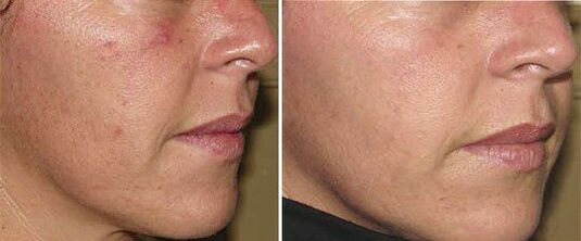Rostro antes y después del rejuvenecimiento de la piel. 